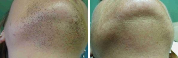 Before and After Image: Laser Hair Removal Before and After Photos in Houston, TX, Patient 8051 - front