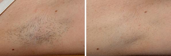 Before and After Image: Laser Hair Removal Before and After Photos in Houston, TX, Patient 8054 - front