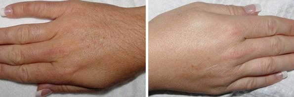 Before and After Image: Laser Hair Removal Before and After Photos in Houston, TX, Patient 8036 - front