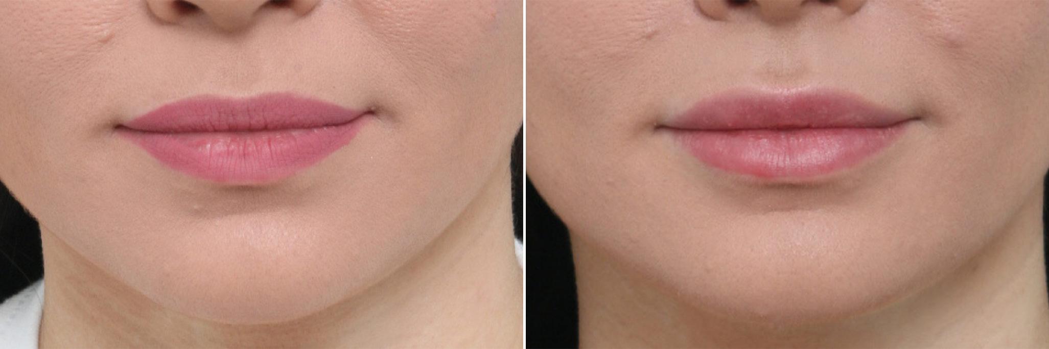 Before and After Image: Lip Enhancement Before and After Photos in Houston, TX, Patient 8082 - front