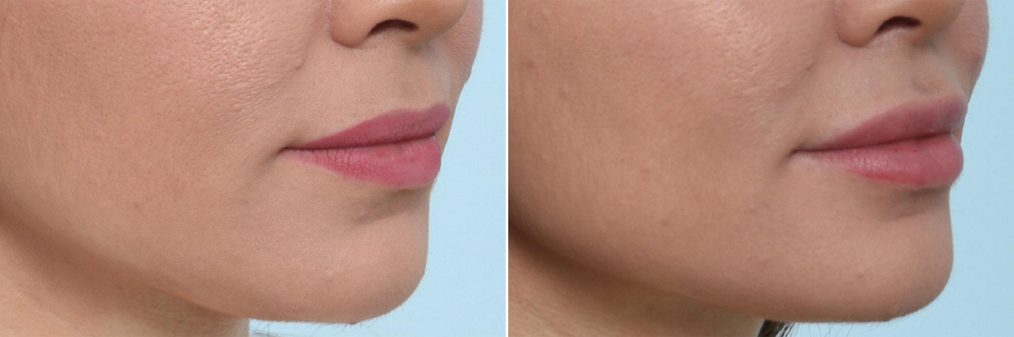 Before and After Image: Lip Enhancement Before and After Photos in Houston, TX, Patient 8082 - right-front-oblique