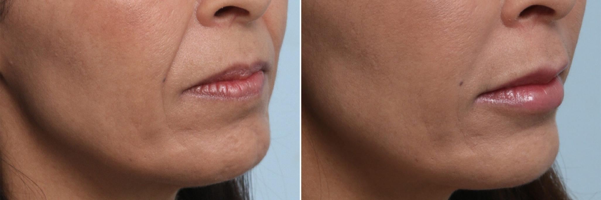 Before and After Image: Lip Enhancement Before and After Photos in Houston, TX, Patient 8062 - right-front-oblique