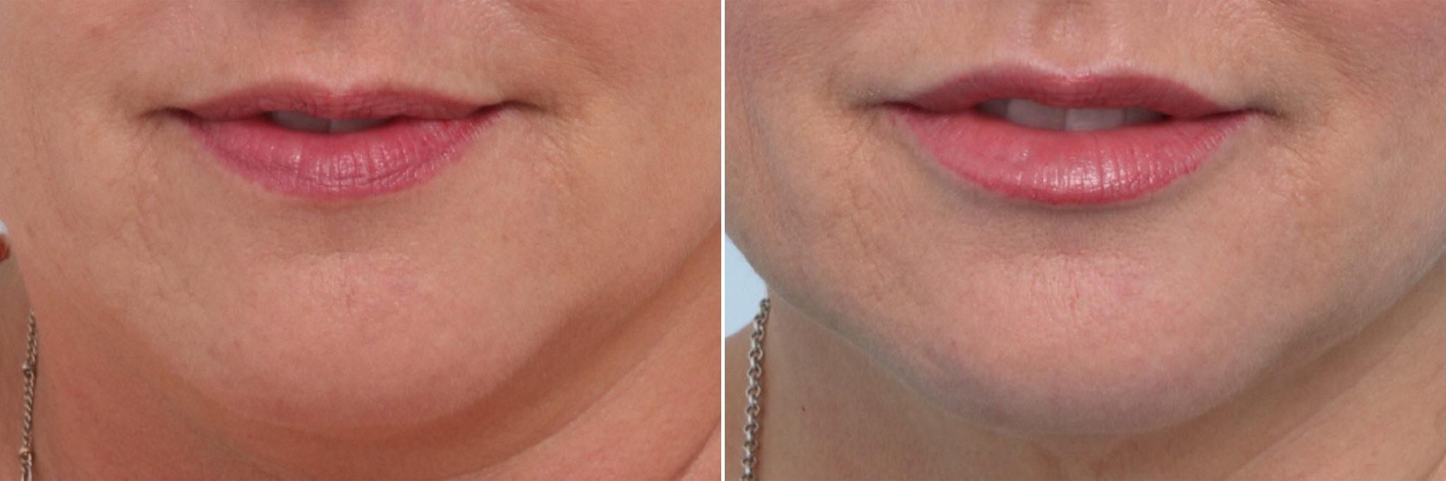Before and After Image: Lip Enhancement Before and After Photos in Houston, TX, Patient 8067 - front
