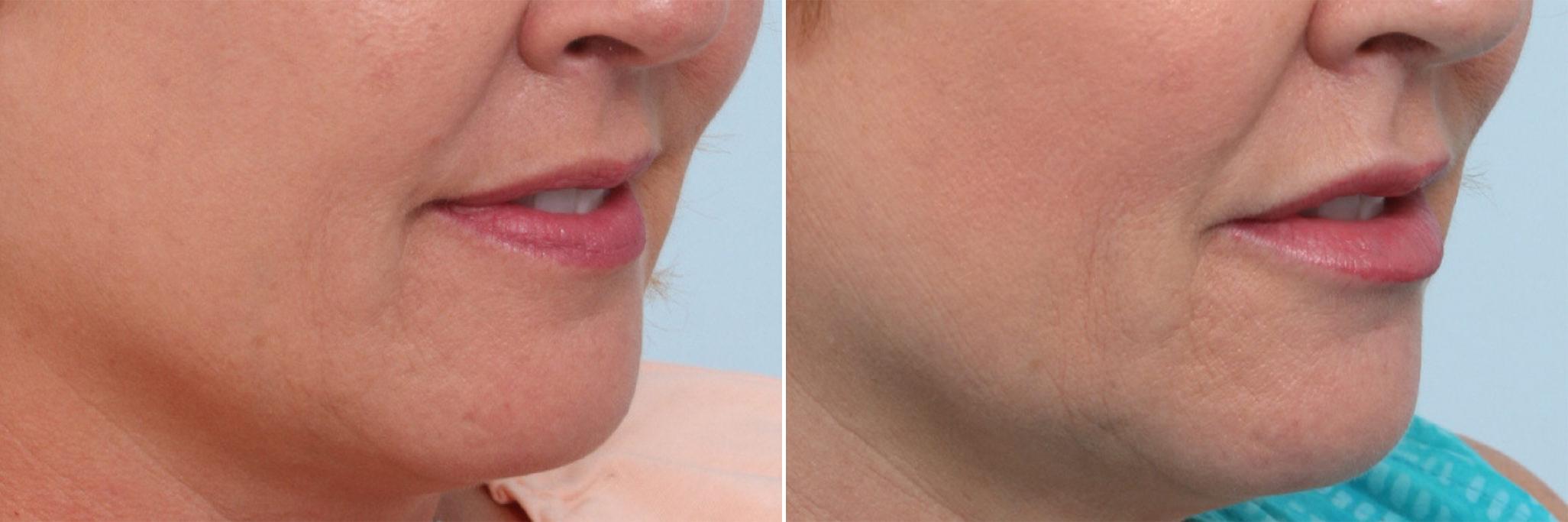 Before and After Image: Lip Enhancement Before and After Photos in Houston, TX, Patient 8067 - right-front-oblique