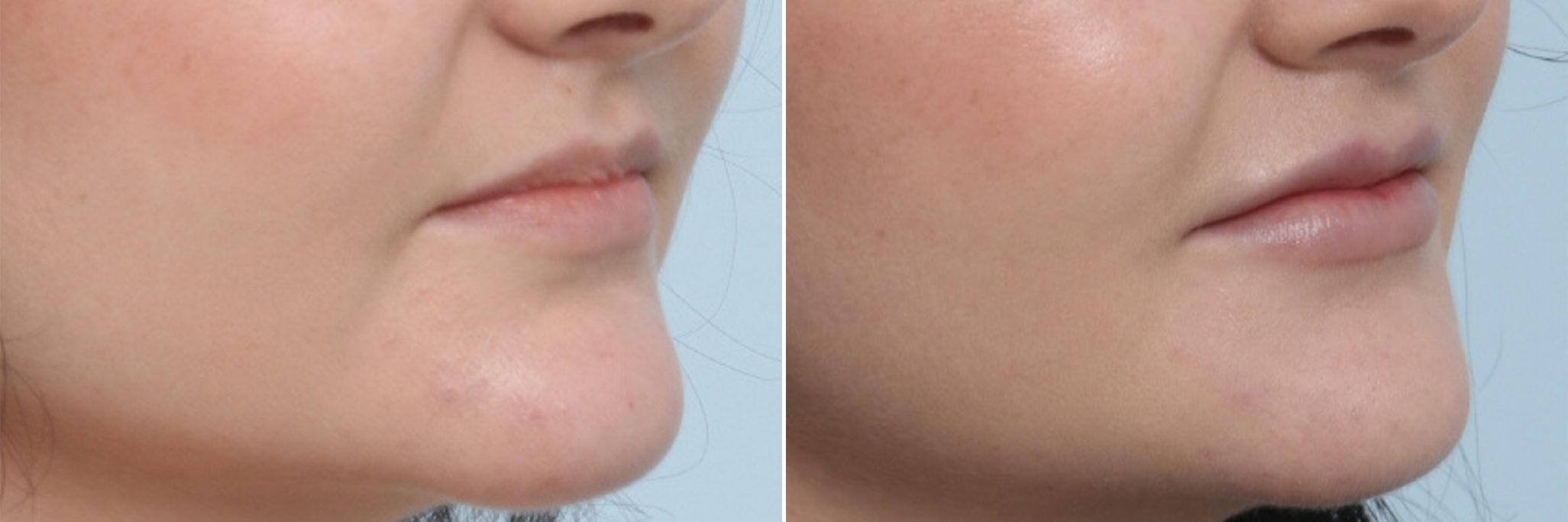 Before and After Image: Lip Enhancement Before and After Photos in Houston, TX, Patient 8072 - right-front-oblique