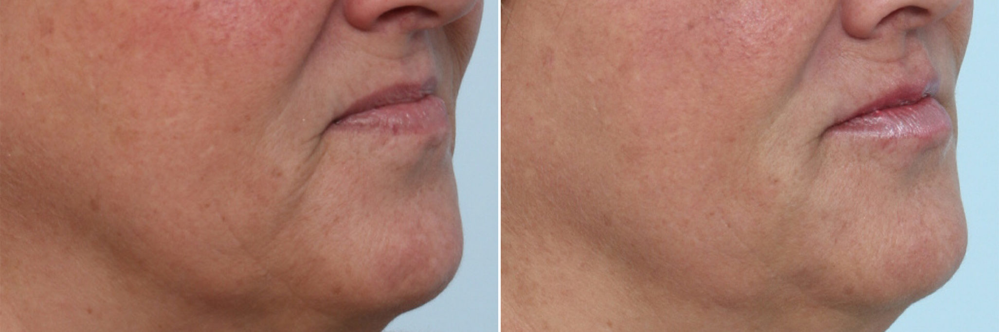 Before and After Image: Lip Enhancement Before and After Photos in Houston, TX, Patient 8077 - right-front-oblique