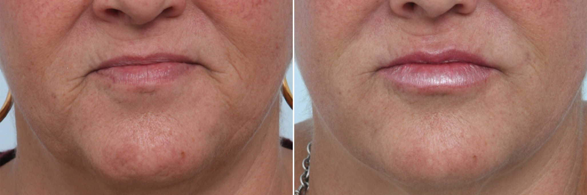 Before and After Image: Lip Enhancement Before and After Photos in Houston, TX, Patient 8077 - front