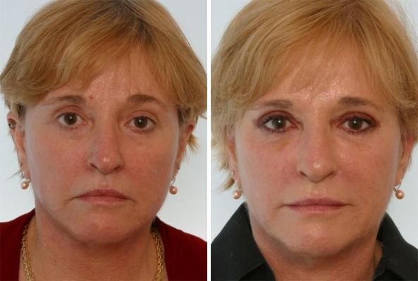 Before and After Image: Fillers Before and After Photos in Houston, TX, Patient 8149 - front