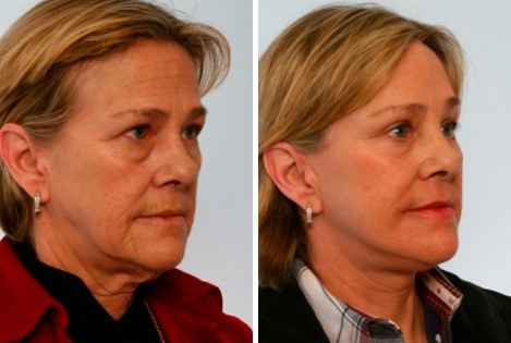 Before and After Image: Fillers Before and After Photos in Houston, TX, Patient 8154 - right-front-oblique