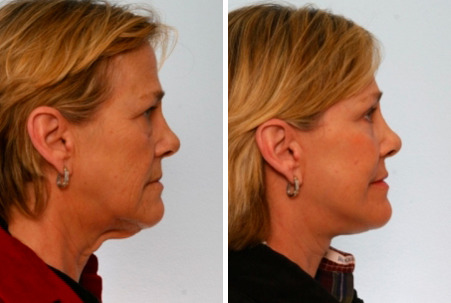Before and After Image: Fillers Before and After Photos in Houston, TX, Patient 8154 - right-side