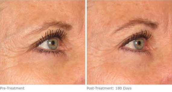 patient 8202 ulthera lift before after 10 570x308 patient 8202 ulthera lift before after 10 570x308