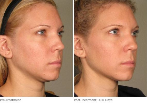 patient 8268 ulthera lift before after 12 570x400 patient 8268 ulthera lift before after 12 570x400
