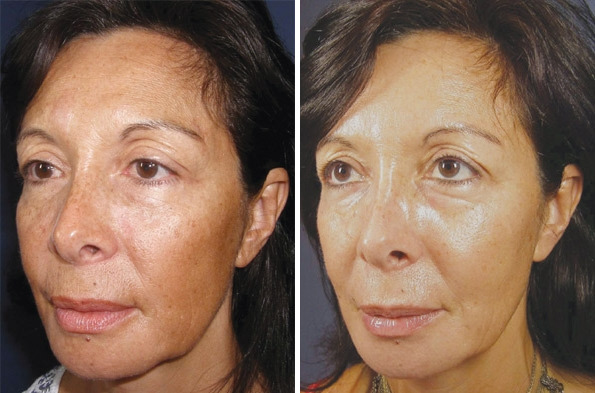 Before and After Image: Chemical Peels Before and After Photos in Houston, TX, Patient 8348 - left-front-oblique