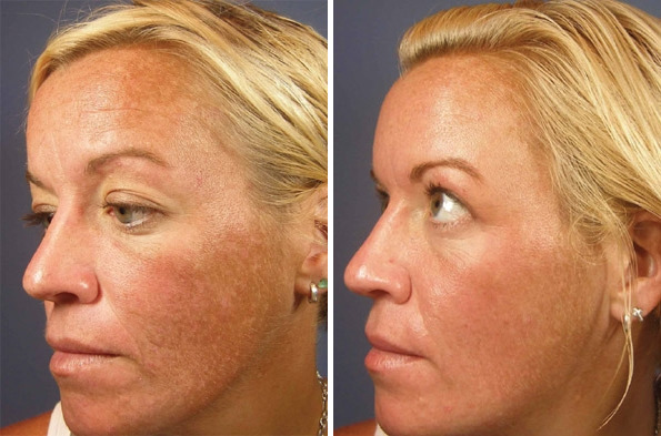 Before and After Image: Chemical Peels Before and After Photos in Houston, TX, Patient 8351 - left-front-oblique