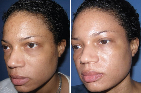 Before and After Image: Chemical Peels Before and After Photos in Houston, TX, Patient 8354 - left-front-oblique