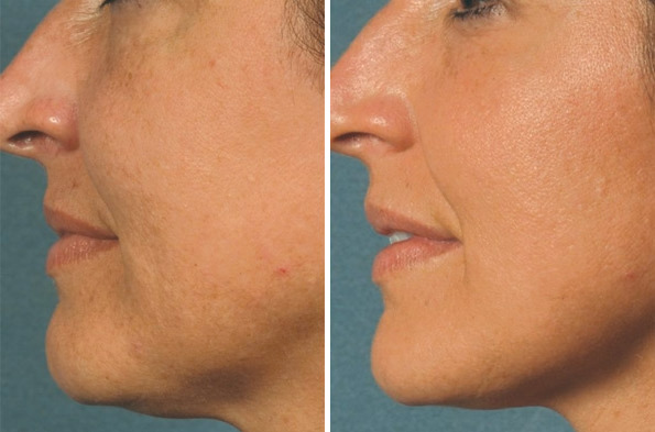 Before and After Image: Chemical Peels Before and After Photos in Houston, TX, Patient 8357 - left-side