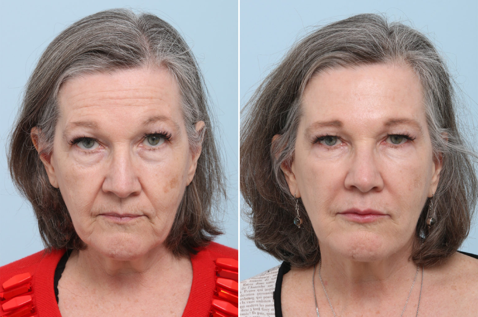 Before and After Image: Fillers Before and After Photos in Houston, TX, Patient 8365 - front