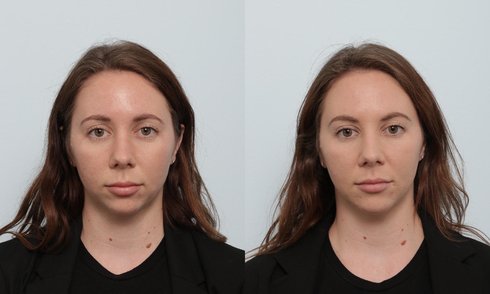 Before and After Image: Fillers Before and After Photos in Houston, TX, Patient 17515