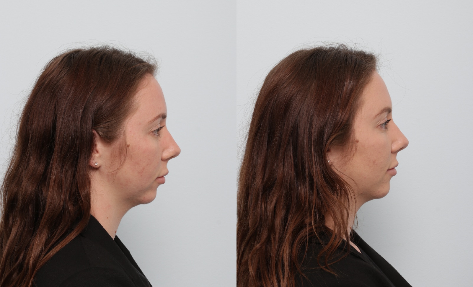 Before and After Image: Fillers Before and After Photos in Houston, TX, Patient 17515 - right-side