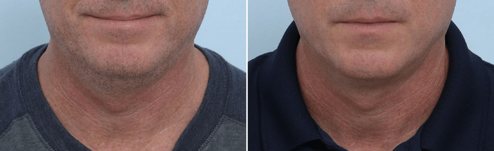 120683 coolsculpting before and after photos 14002