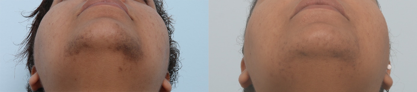 Before and After Image: Laser Hair Removal Before and After Photos in Houston, TX, Patient 17568 - front