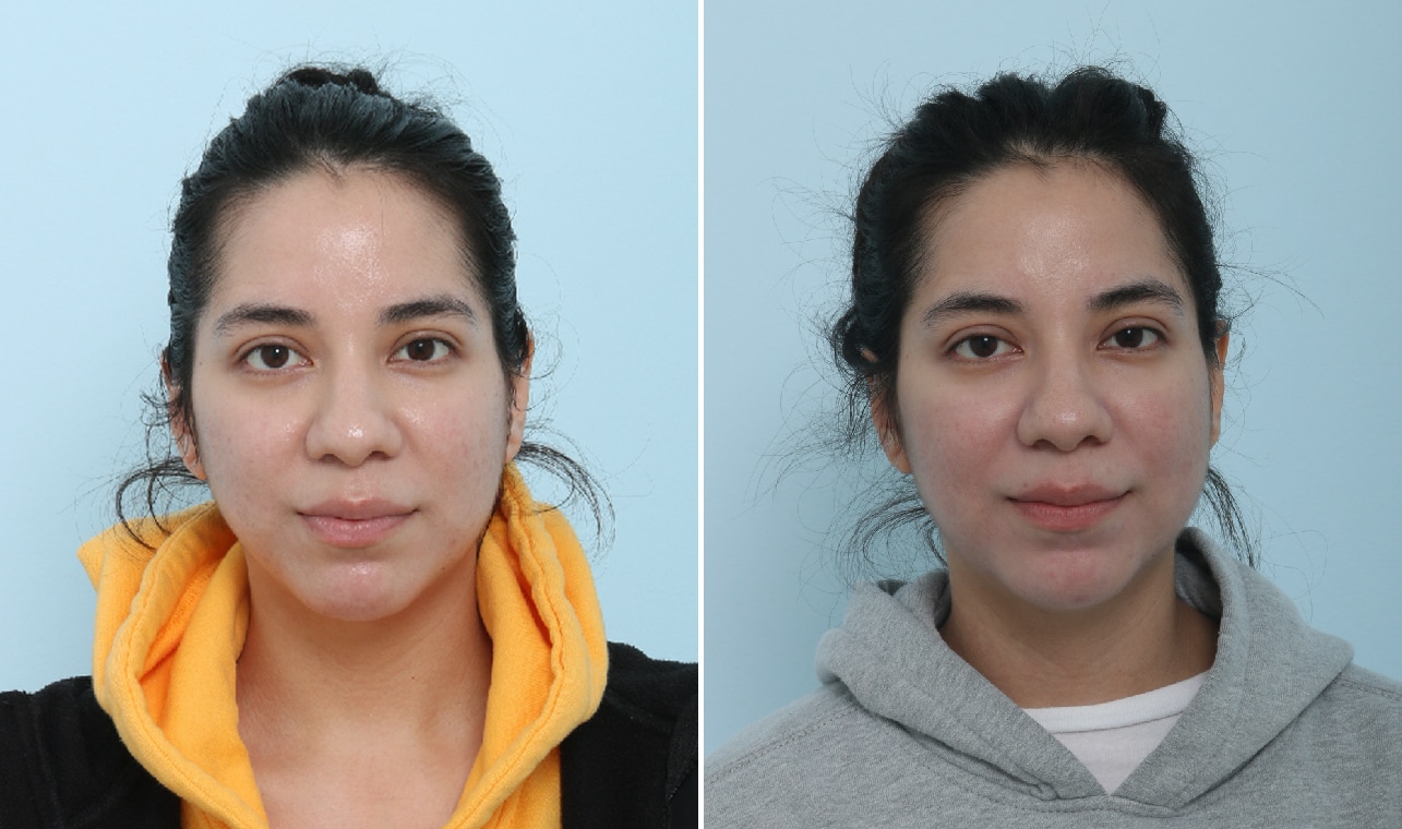 Before and After Image: Fraxel Laser Before and After Photos in Houston, TX, Patient 17570 - front
