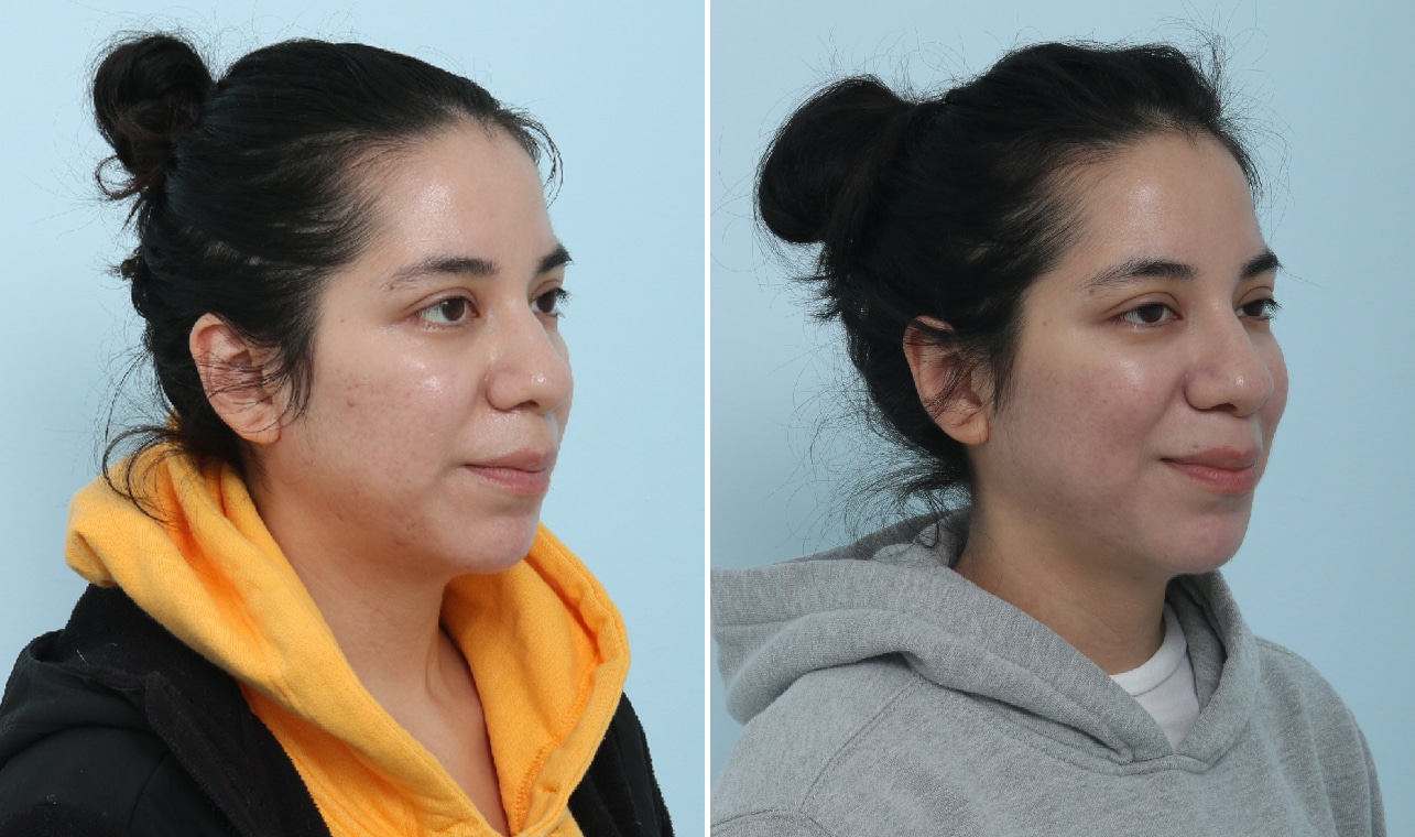 Before and After Image: Fraxel Laser Before and After Photos in Houston, TX, Patient 17570 - right-front-oblique