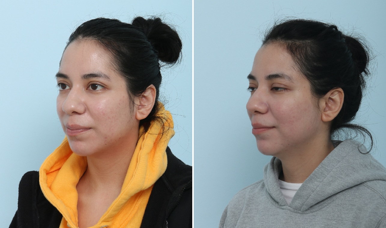 Before and After Image: Fraxel Laser Before and After Photos in Houston, TX, Patient 17570 - left-front-oblique