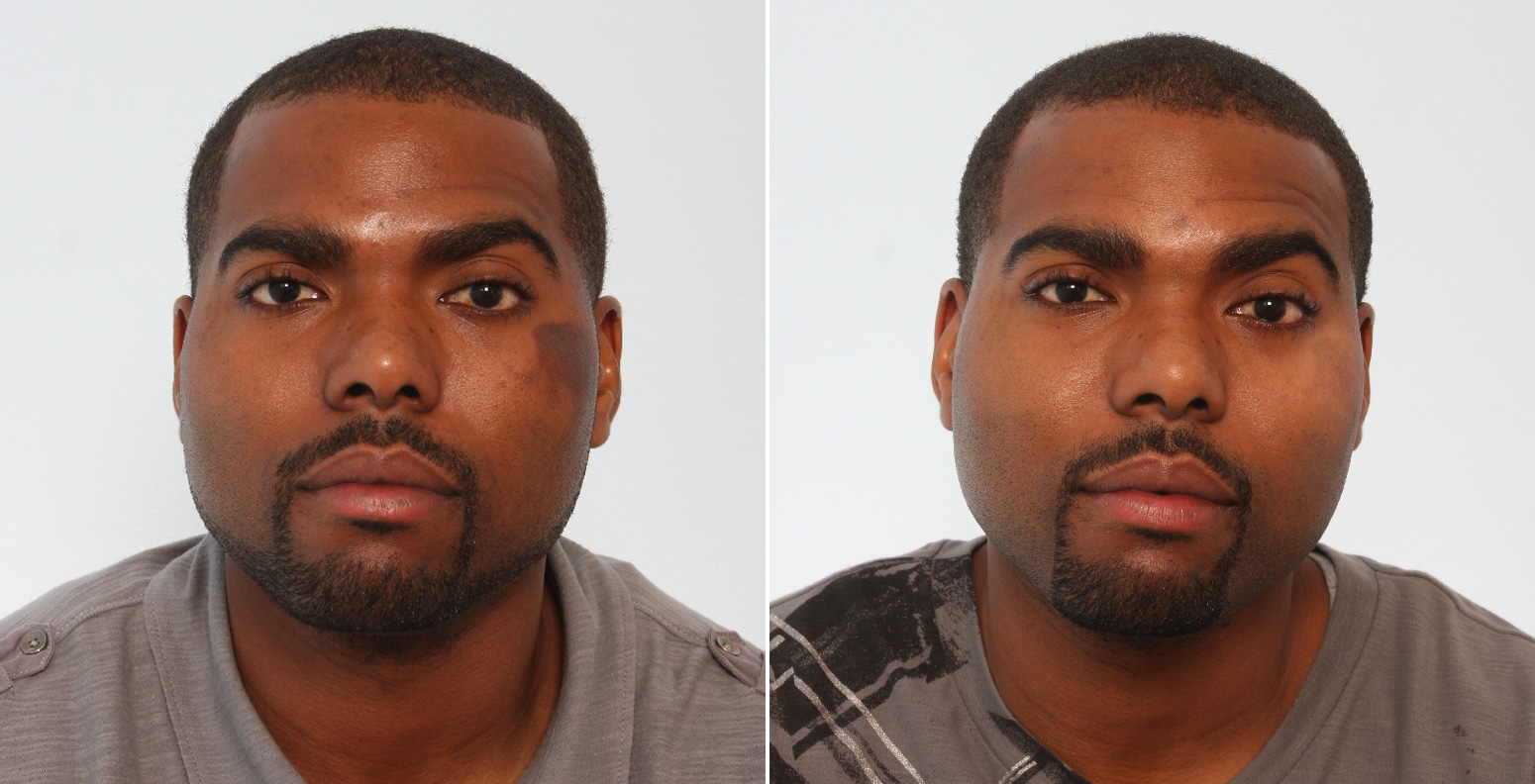 Before and After Image: Laser Genesis Before and After Photos in Houston, TX, Patient 17580 - front