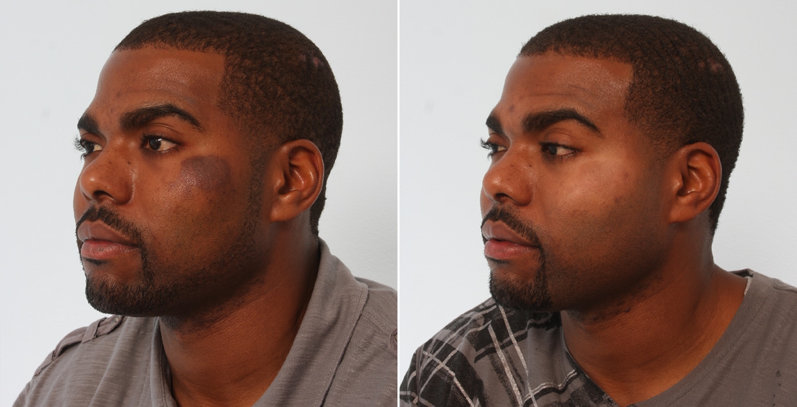 Before and After Image: Laser Genesis Before and After Photos in Houston, TX, Patient 17580 - left-front-oblique