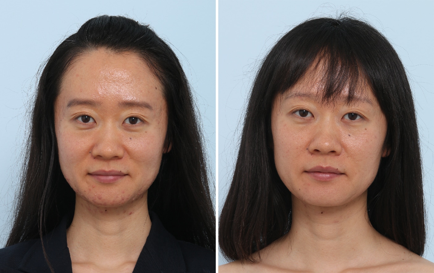 Before and After Image: Chemical Peels Before and After Photos in Houston, TX, Patient 17584 - front