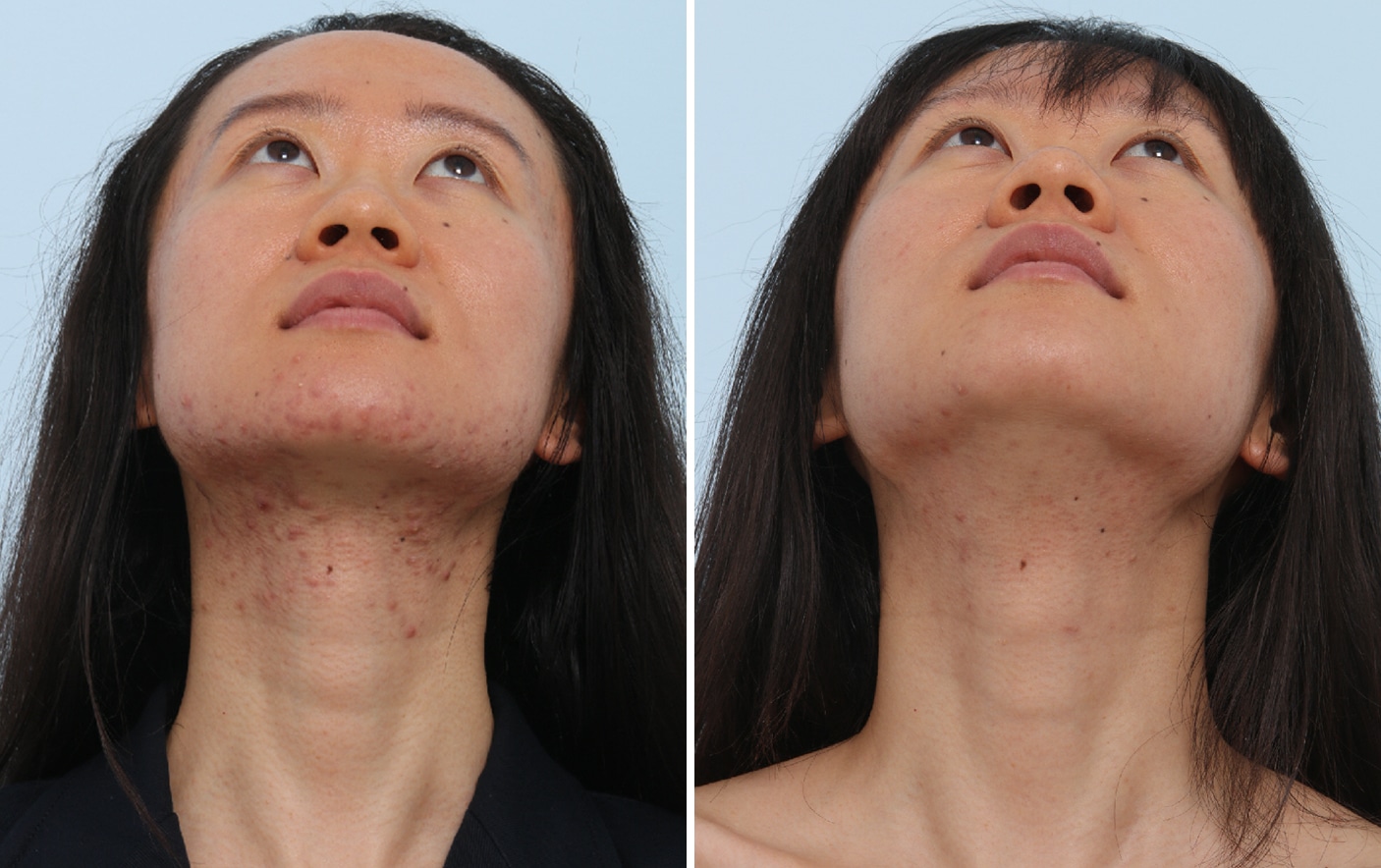 Before and After Image: Chemical Peels Before and After Photos in Houston, TX, Patient 17584 - front