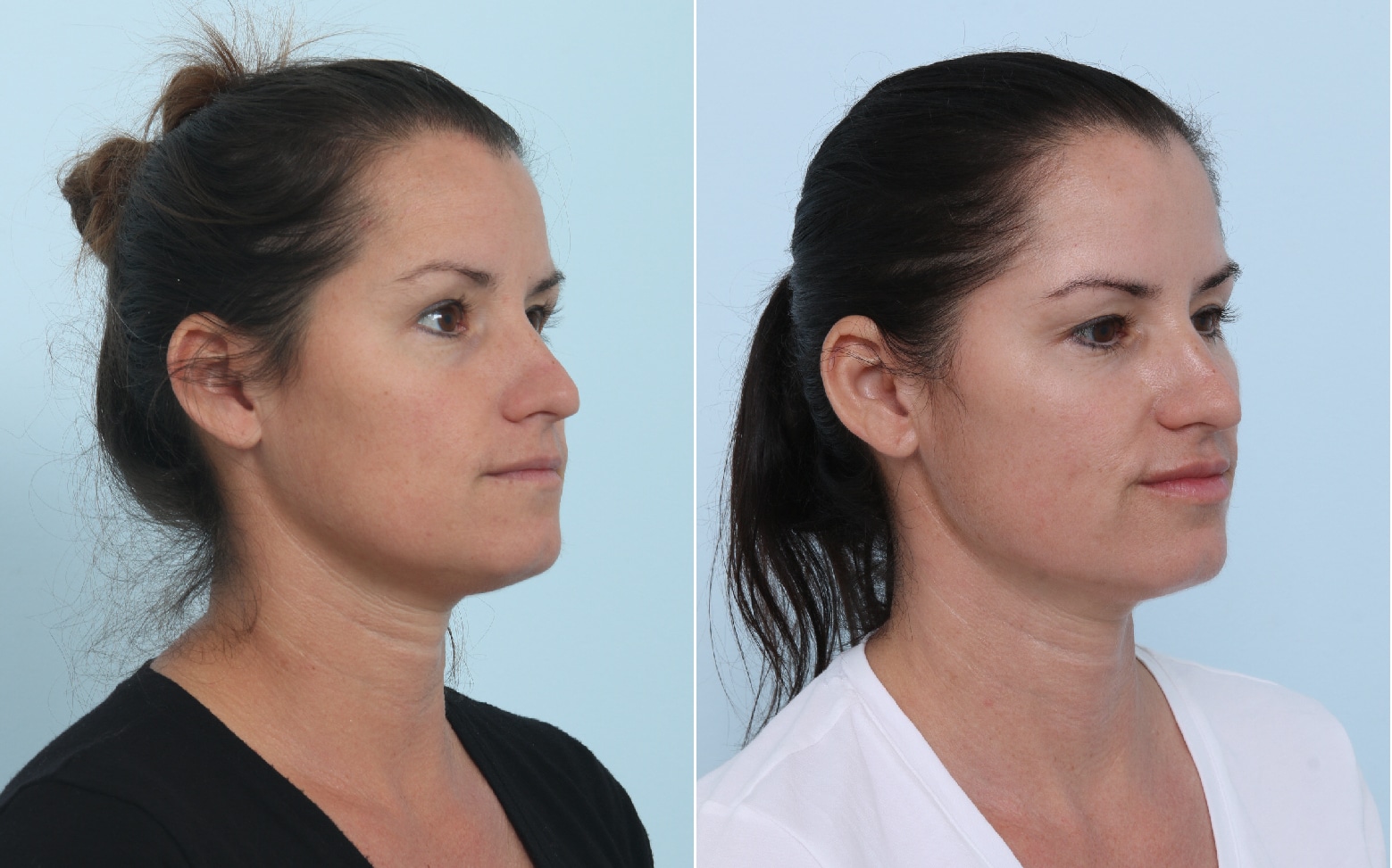 Before and After Image: Fraxel Laser Before and After Photos in Houston, TX, Patient 17806 - right-front-oblique
