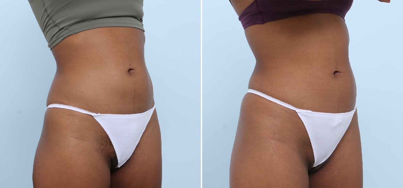 Before and After Image: CoolSculpting Before and After Photos in Houston, TX, Patient 17818 - right-front-oblique