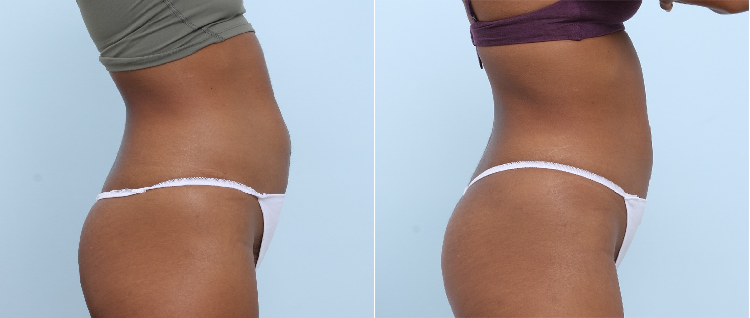 Before and After Image: CoolSculpting Before and After Photos in Houston, TX, Patient 17818 - right-side