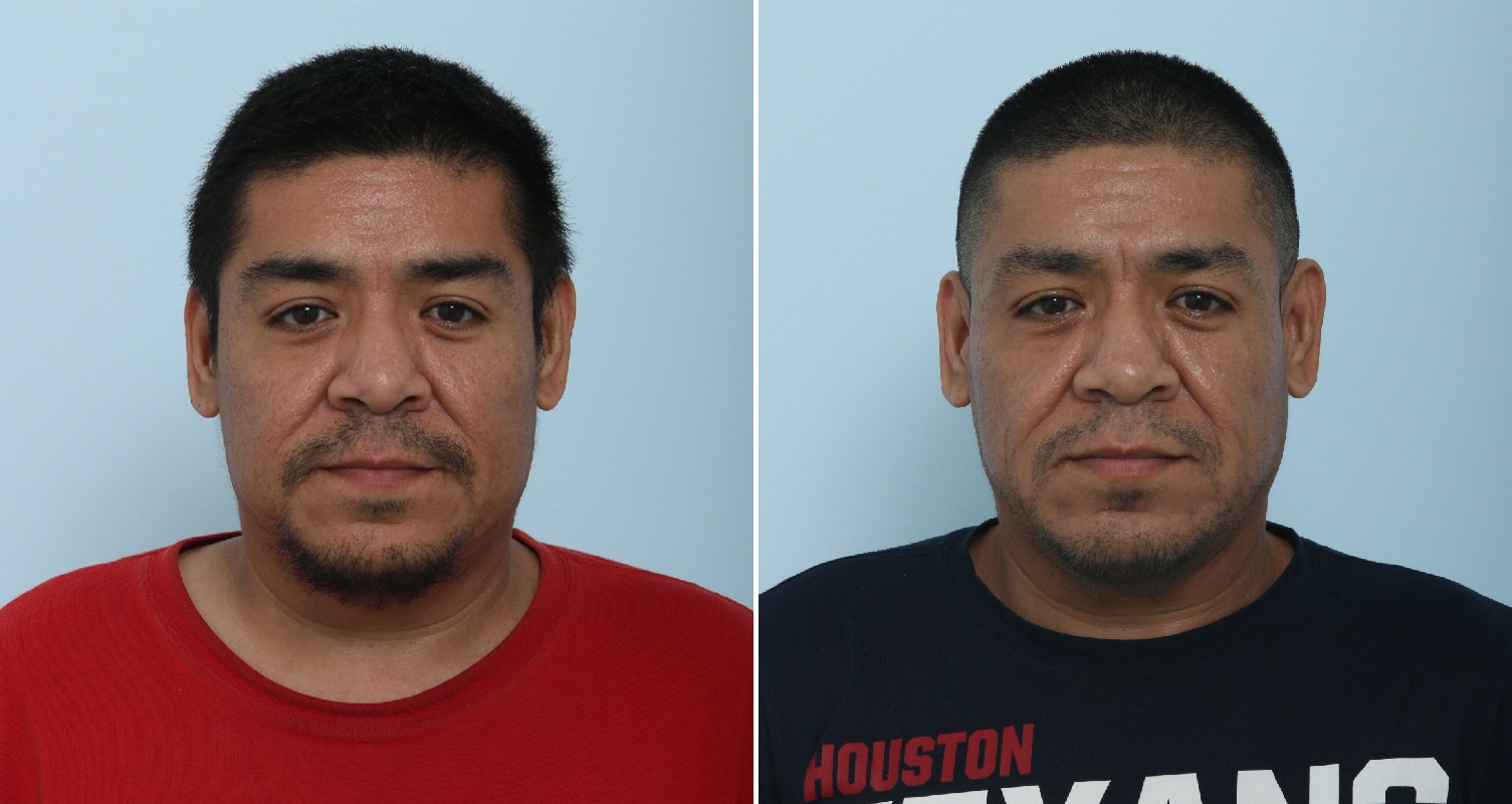 Before and After Image: Fraxel Laser Before and After Photos in Houston, TX, Patient 17810