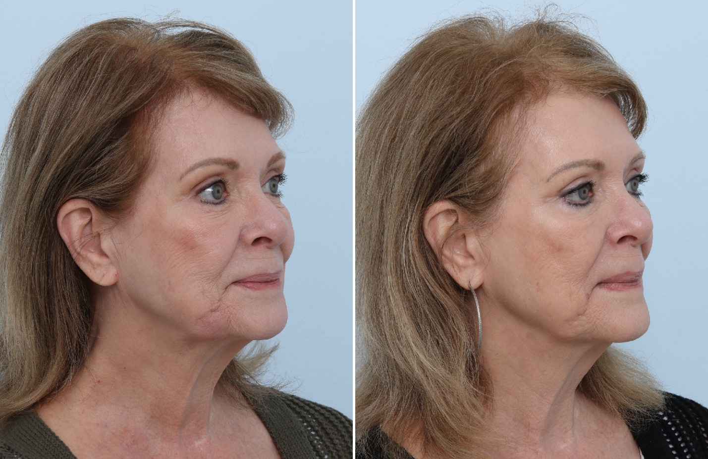 Before and After Image: SkinPen® Microneedling with Growth Factors Before and After Photos in Houston, TX, Patient - right-front-oblique