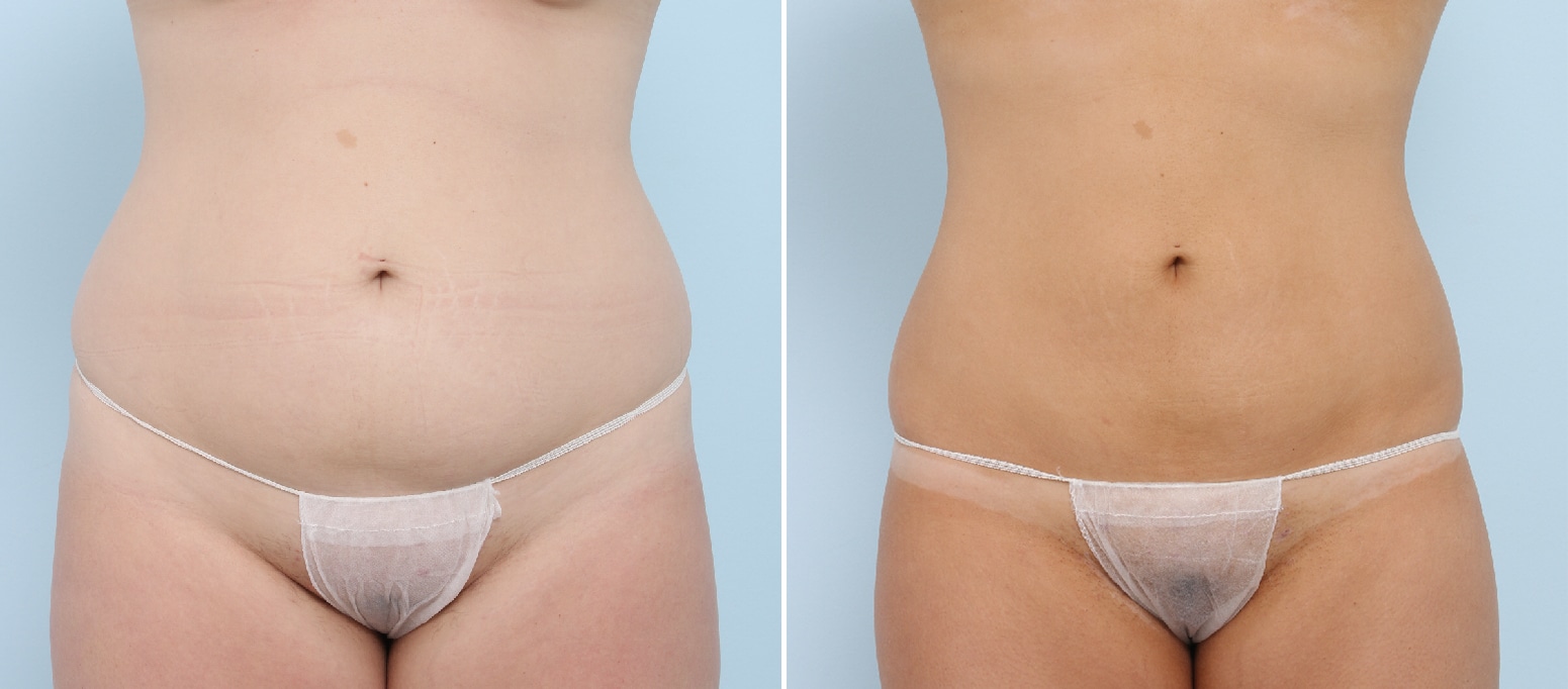 Before and After Image: CoolSculpting Before and After Photos in Houston, TX, Patient 17839