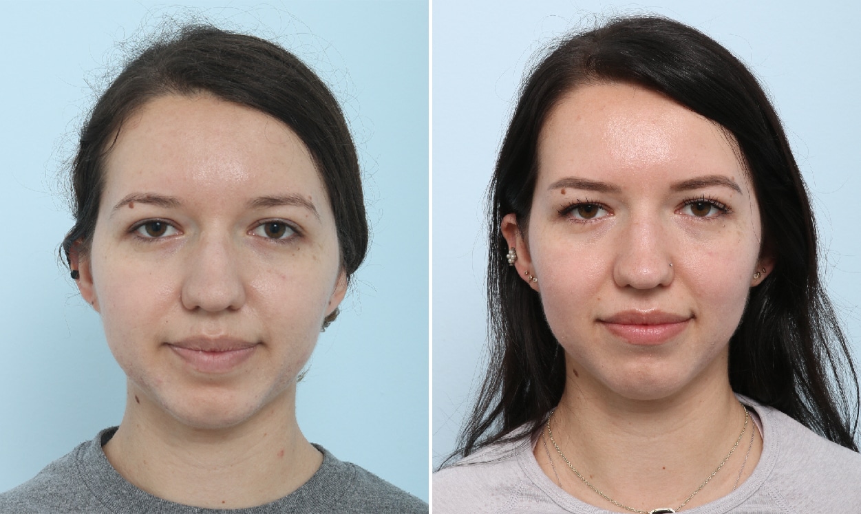 Before and After Image: Fraxel Laser Before and After Photos in Houston, TX, Patient 17864 - front