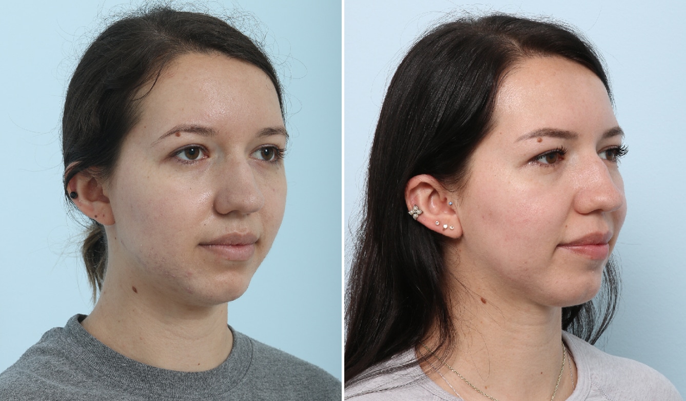 Before and After Image: Fraxel Laser Before and After Photos in Houston, TX, Patient 17864 - right-front-oblique