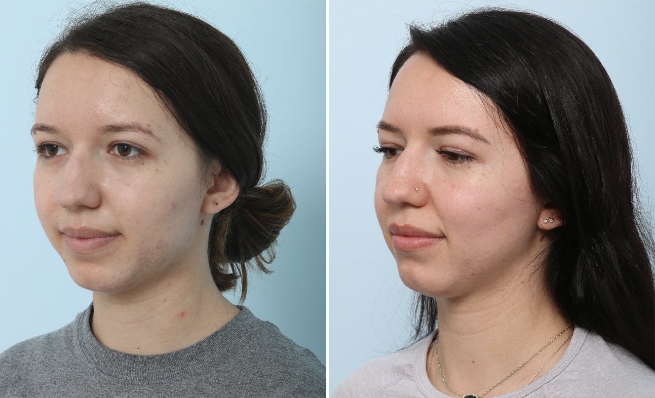 Before and After Image: Fraxel Laser Before and After Photos in Houston, TX, Patient 17864 - left-front-oblique